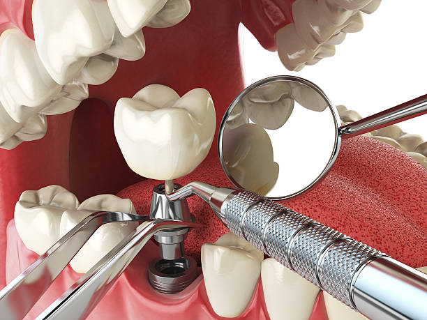 Best Emergency Wisdom Tooth Extraction in Boise City, OK